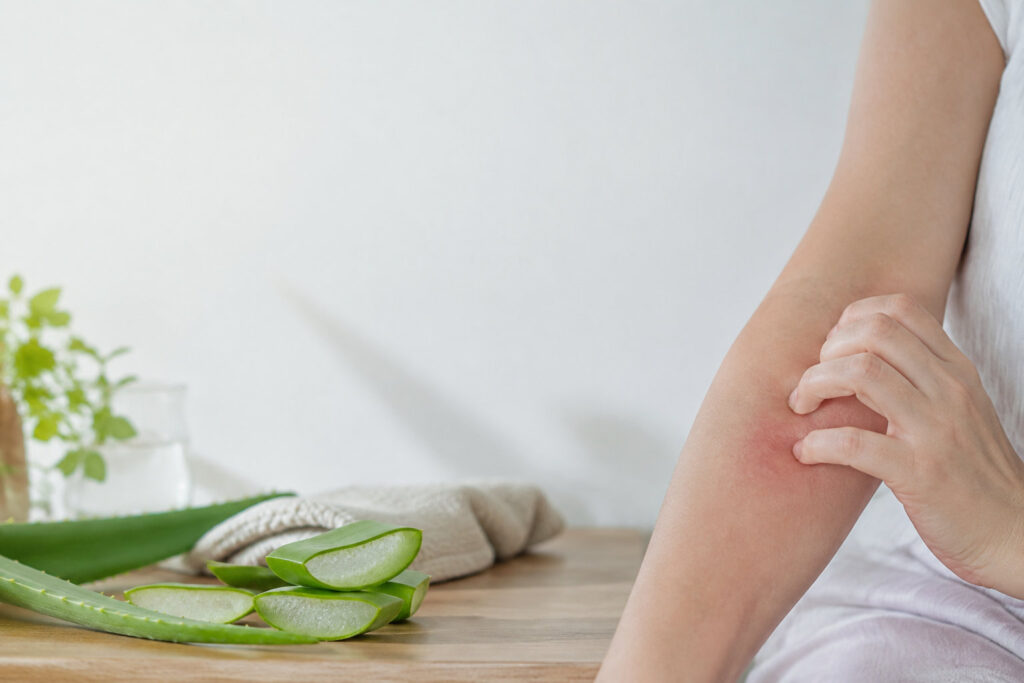 Une personne gratte une zone de peau rouge sur son bras à côté de tranches d'aloe vera fraîche sur une table.